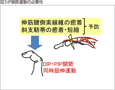 図3:IP関節運動の必要性 